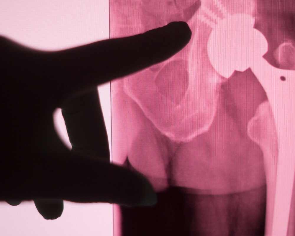 pink hip xray pink hip xray